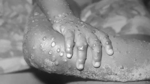 Viruela del mono: contagios han aumentado un 77% en la última semana