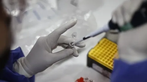 Casos de Viruela del Mono aumentan 95% en una semana en Chile