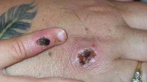 ¿Cuántos casos de la Viruela del Mono informaron hoy en Chile?