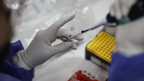 ¿Cuáles son los síntomas más comunes de la Viruela del Mono?