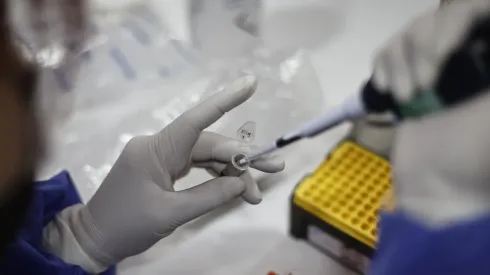 Minsal reporta 730 casos de viruela del mono en Chile