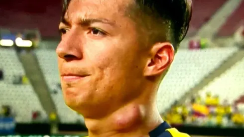 Así se vio el cuello de Alan Franco, quien salió lesionado por una molestia de isquiotibial en el amistoso frente a Arabia Saudita.