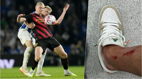 Erling Haaland terminó con sus piernas ensangrentadas tras el duelo con Brighton. Foto: Getty Images/Instagram