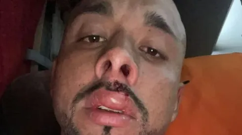 Así le quedó el rostro a Bernardo Cerezo tras el partido ante la U.