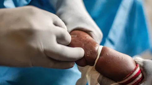 MINSAL ya habia alertado sobre esta enfermedad en 2022.