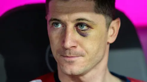 Eye, eye! Bayern star Lewandowski sports a shiner