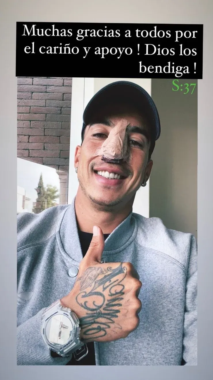 Diego Rigonato mostró su nariz