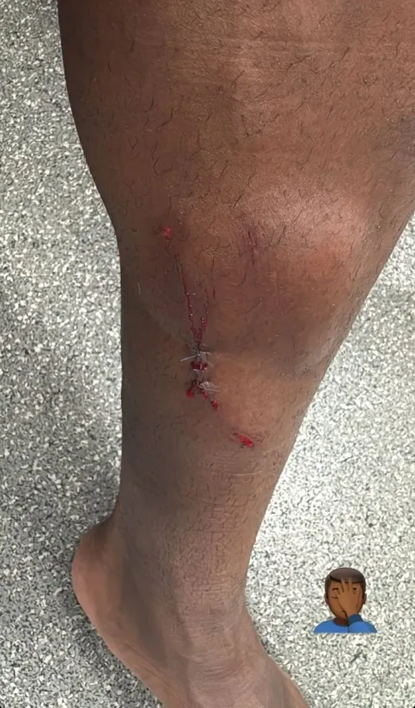 La imagen que publicó Helinho de su cicatriz.