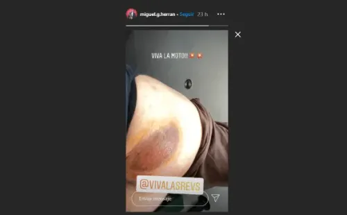Las heridas que sufrió Miguel Herrán por el accidente en moto.
