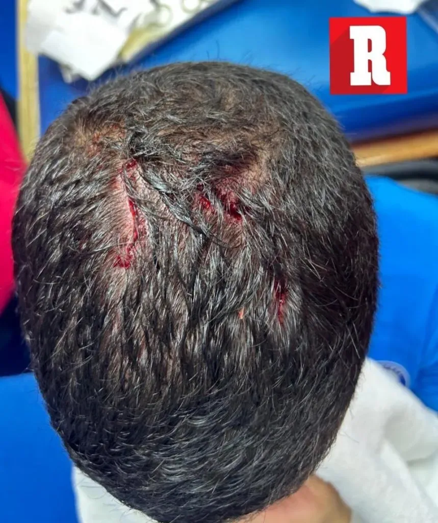 Así le quedó la cabeza a Nacho Rivero después del planchazo de Nico Díaz (Récord)
