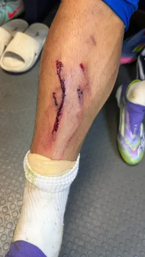 Así quedó la pierna del Chiquete Orozco