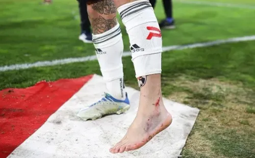 Así quedó el pie y el tobillo de Maxi Falcón tras planchazo recibido por parte de Cris Martínez el sábado. | Foto: Agencia UNO.