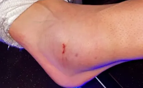 Así quedó el tobillo de Ronald Matarrita (Foto: Instagram de Ronald Matarrita)