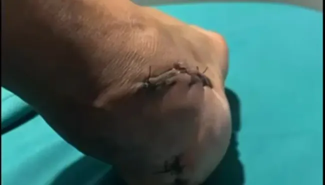 Así está el tobillo de Ricardo Blanco.