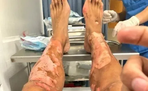 Así quedaron las piernas de Mathías Cardacio. Foto: El Observador.