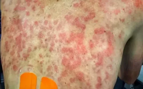 Así quedó la espalda de los ciclistas tras la lluvia de granizos.