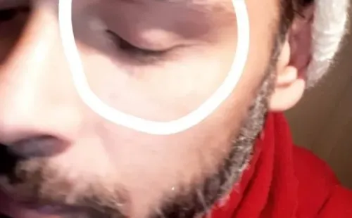 Oscar Garcés muestra sus heridas en Instagram.(1)