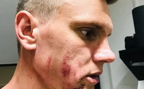 Así quedó el rostro de Fiedrich tras el planchazo.