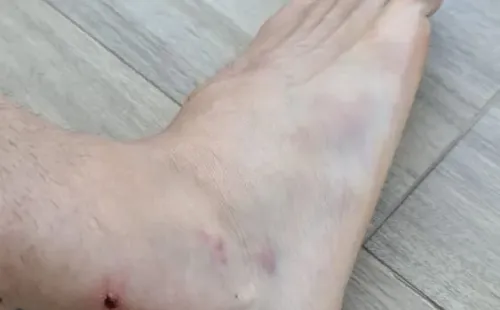 Así amaneció el pie de Aveldaño