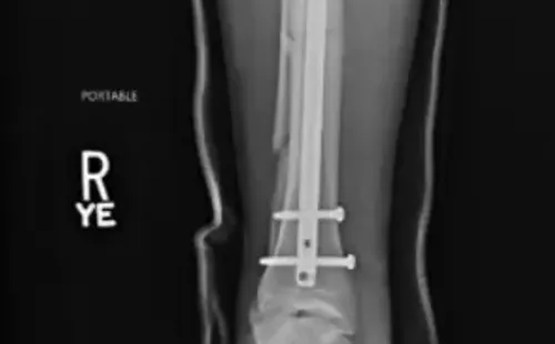 Weidman terminó con un fierro y tres tornillos. Foto: Twitter