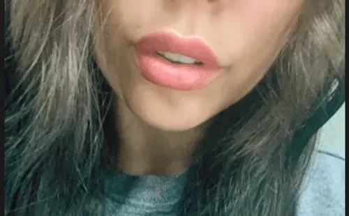 Las historias con que Daniela Aránguiz mostró su nueva boca.(4)