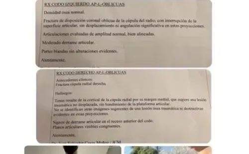 Las historias de Nano Calderon relatando su accidente, por salvar a la perrita que escapó de su dueña.(2)