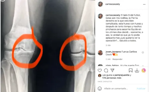 La radiografía que compartió Carlos Caszely, mostrando su rodilla pulverizada.