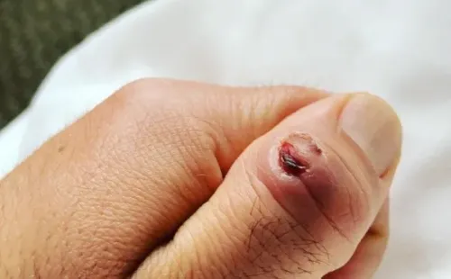 La publicación de Álvaro López tras compartir el estado de su dedo, tras el corte que sufrió en el primer episodio de Masterchef Celebrity.(2)