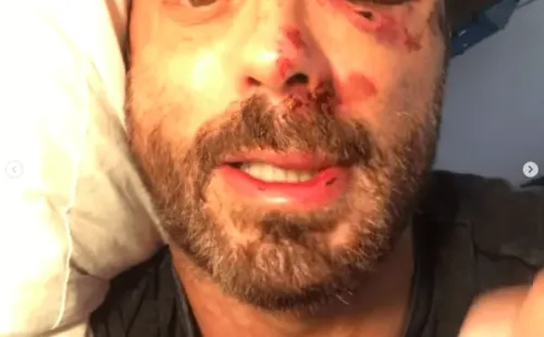 Las heridas de Javier Fernández tras el accidente en bicicleta.