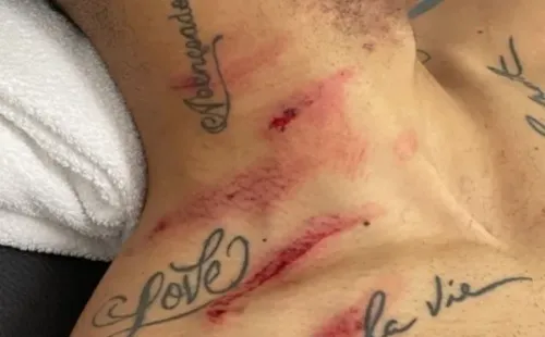 Matheus Cunha mostró en sus redes sociales como le quedó el cuello después de la tremenda patada que le dio Alexander Domínguez. (Foto: Captura Instagram Matheus Cunha)