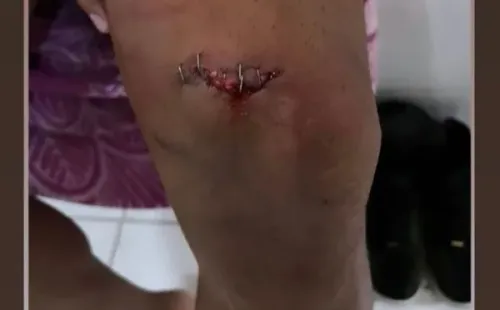 La imagen de la rodilla de Cerezo que mostró Ñublense en sus redes sociales.