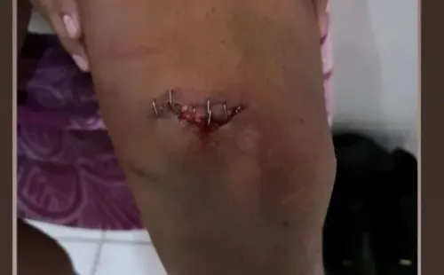 Ñublense mostró cómo quedó la pierna izquierda de Cerezo