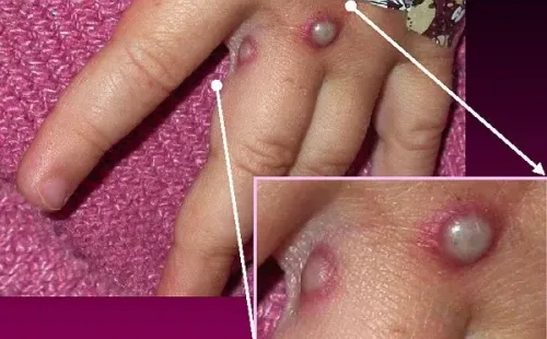 Erupción en la piel por viruela del mono (Agencia UNO)