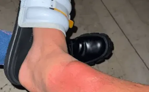 La pierna de Arturo Vidal quedó golpeada tras la final de Copa do Brasil.
