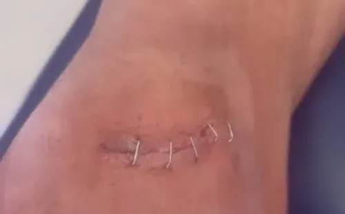 Así lucía la herida de Mauricio Isla este miércoles 2 de noviembre. (Instagram).