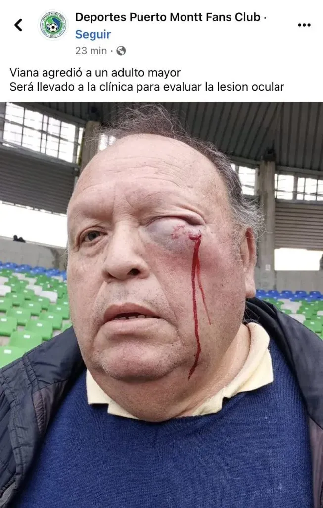 Así quedó el ojo del hincha agredido por el portero en Puerto Montt.