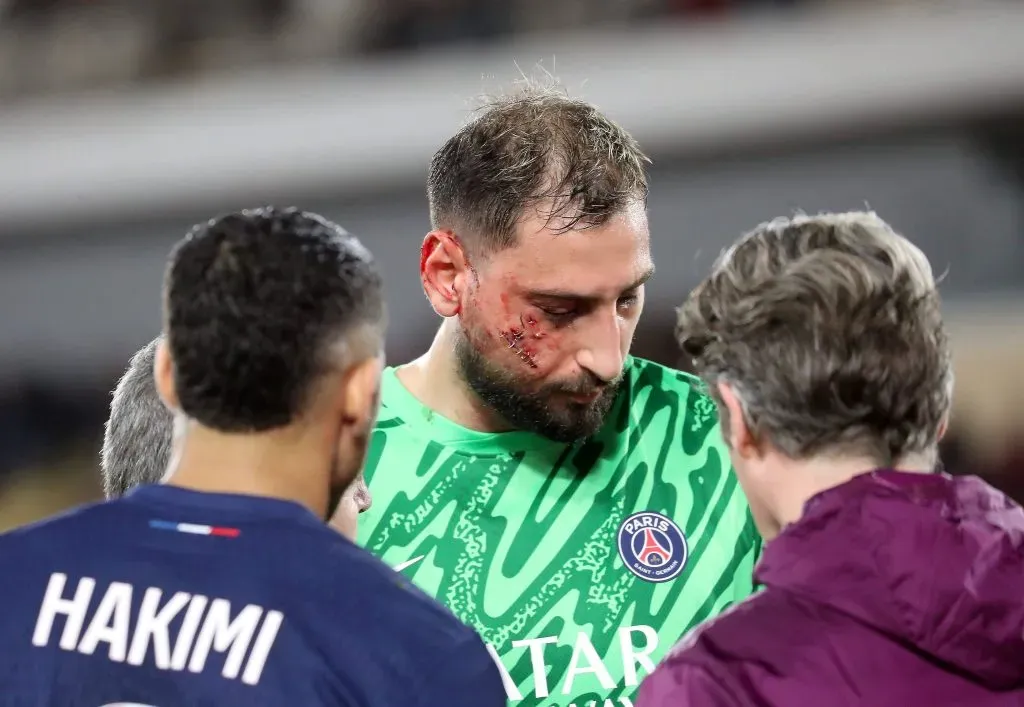 Así terminó el rostro de Gianluigi Donnarumma tras el patadón que recibió y que hizo a muchos recordar a Raúl Olivares ante la U. Foto: IMAGO.