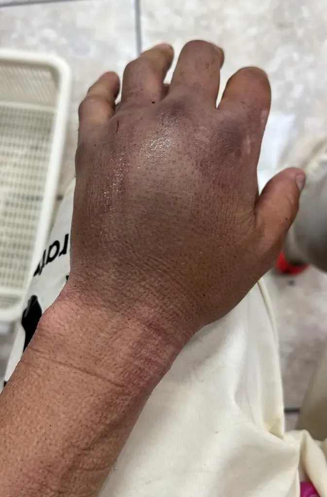 Así quedó la mano de Rodrigo Ureña tras recibir un fuerte pisotón en Perú. | Foto: Jean Ferrari.