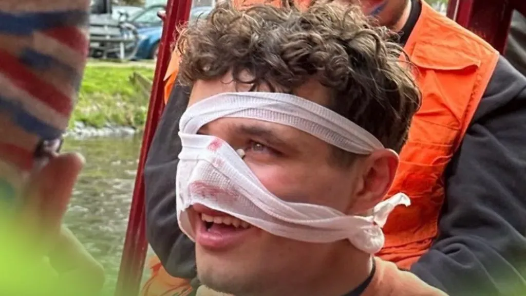 Lando Norris con una lesión en la nariz en 2024.