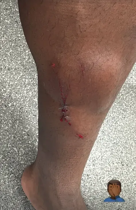 Así quedó la pierna de Helinho tras el tremendo planchazo de Igor Lichnovsky. Foto: Instagram.